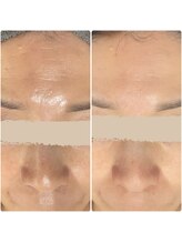 ≪毛穴洗浄肌質改善/小顔たるみケアSalon≫　泡のきもち【12/1 NEW OPEN（予定）】/ハリ艶うるおいケア