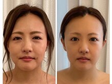 サロンメロウ 大牟田店(salon mellow)/オーダーメイド小顔矯正