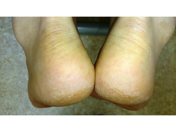 ツルミ(Tsurumi)/施術後 脚長差