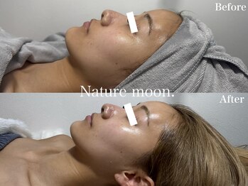 ナチュールムーン(Nature moon.)/ハーブピーリング
