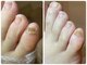ココン フワット(cocon fouato)の写真/夏に向けて自信の持てる素足へ♪凸凹爪/小さな爪/魚の目/硬くなった角質もプロによるケアでしっかり改善！