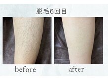 ビービーサロン(B.B.salon)の雰囲気（脱毛6回目before after）