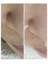毛穴塾/部分フェイシャルWAX脱毛☆