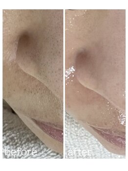 毛穴塾/部分フェイシャルWAX脱毛☆