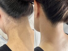 シロ(Shiro)/MIX脱毛うなじデザイン