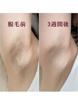 アウラ(AURA)/1回施術後2回目来店時☆