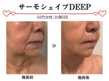 スパイア(SPIRE)/サーモシェイプDEEP★お顔