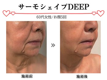 スパイア(SPIRE)/サーモシェイプDEEP★お顔