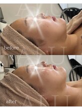 アルフォービューティー 難波店(ALU for beauty)/オンダリフト症例