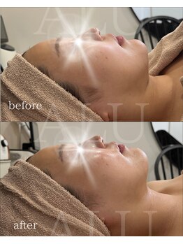 アルフォービューティー 難波店(ALU for beauty)/オンダリフト症例