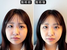 アオヤマ サロン ワイゼット(AOYAMA SALON YZ)/LEDで写真映え小顔へ