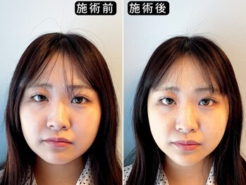 アオヤマ サロン ワイゼット(AOYAMA SALON YZ)/LEDで写真映え小顔へ