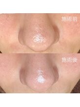 エクラ バイ シャンリィ(eclat by shanLy)/毛穴洗浄！