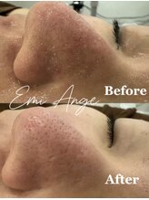 エミアンジュ(Emi Ange)/毛穴洗浄【黒ずみ/くすみ/美白】