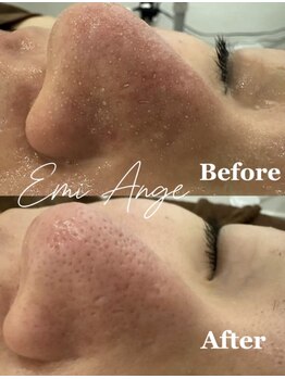 エミアンジュ(Emi Ange)/毛穴洗浄【黒ずみ/くすみ/美白】