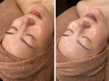 ルシール 仙台店(lucir)/【肌質改善】×【潤い水光肌】