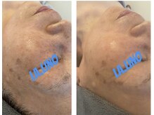 ラ リノ 星ヶ丘(La Lino)/たるみ＆ハリアプローチ