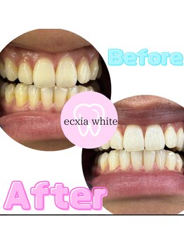 エクシアホワイト 広島袋町店/ホワイトニングビフォーアフター