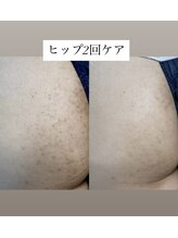 スキンプローズ(skinprose)/ヒップハーブピーリング・ハード