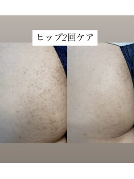 スキンプローズ(skinprose)/ヒップハーブピーリング・ハード