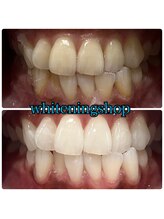 ホワイトニングショップ 三田店/before after