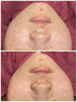 ビマリア(美-MARIA)/ハーブピーリング１回