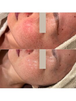 ハル(haru)/ビフォーアフター