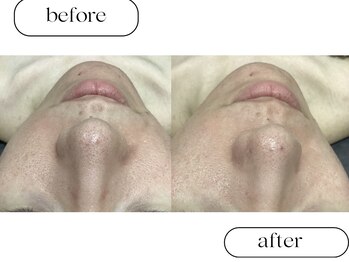 ルボン(RUBON)/ピーリング＋毛穴洗浄