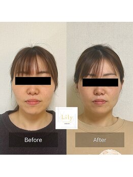リリー(Lily)/ビフォーアフター