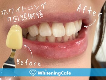 ホワイトニングカフェ 金沢店(WhiteningCafe)/◎歯のホワイトニング施術写真◎
