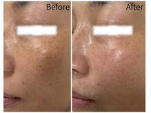 しみなど年齢お肌を改善