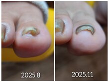 爪切り屋 足楽/【巻き爪】器具でリフトアップ