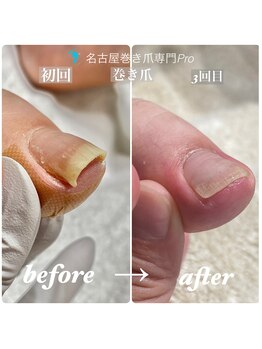 名古屋巻き爪専門Pro/巻き爪補正3回目の変化