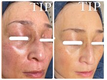 ヒメミ(Himemi)/TIPハーブピーリング