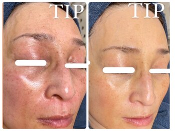 ヒメミ(Himemi)/TIPハーブピーリング