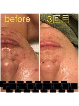 ココ(coco)/ハーブピーリング