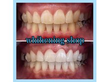 ホワイトニングショップ 天王寺店/10回ご来店後のお写真です