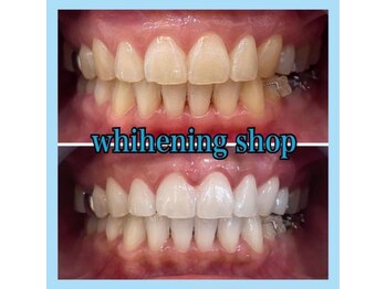 ホワイトニングショップ 天王寺店/10回ご来店後のお写真です