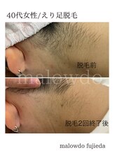 マロウド 藤枝店(malowdo)/人気のえり足/うなじ脱毛