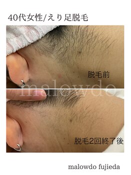 マロウド 藤枝店(malowdo)/人気のえり足/うなじ脱毛