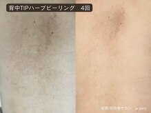 ジュパール(je pars)/背中TIPハーブピーリング