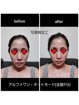 快眠空間/アルファワン施術中例