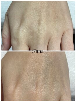 サナ 久が原 千鳥町(S’ana)/ルビッシュ照射