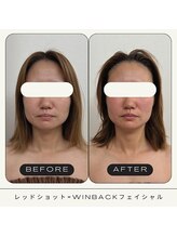 さかうえ接骨院/レッドショット×WINBACK