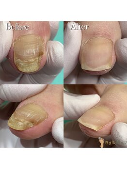 巻き爪補正店 越谷店/変形爪補正