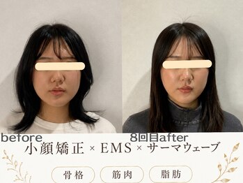 エスポワール(espoir)/エラ張り・頬下がスッキリ