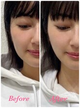 プレッシュ(Presh)/【小顔矯正】#小顔