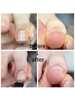 カラーホリック ネイルスパ(Colorholic Nailspa)/巻き爪補正