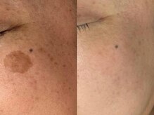 サクラ 伊勢原店(SAKURA)/大きなシミも改善へ