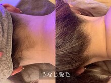 アルム(Arum)/うなじ脱毛